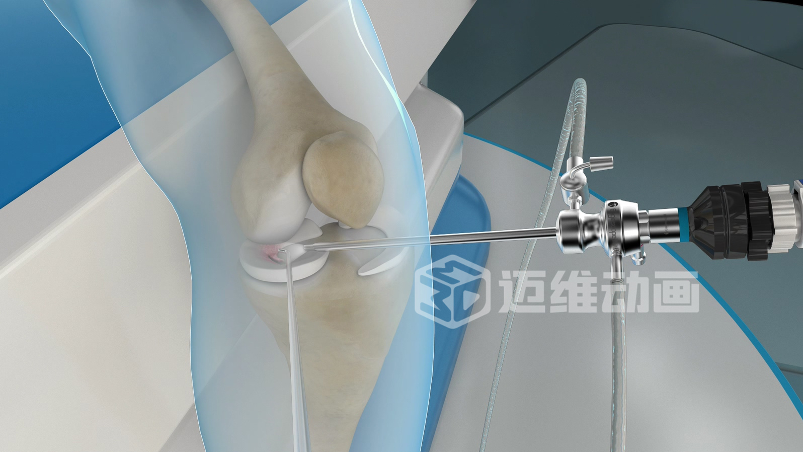 關(guān)節(jié)鏡手術(shù)三維動(dòng)畫